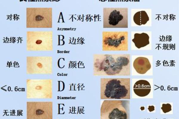 解读痣相：每颗痣背后的命运暗示