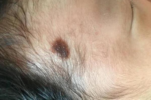 从胎记看命运：命理学告诉你胎记可能的象征