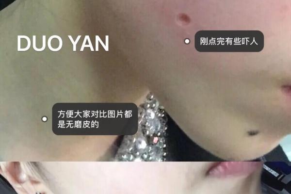 手心有肉痣的人运势如何