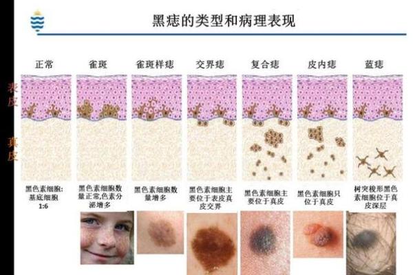 痣相学揭秘：如何通过痣的位置与形状看性格与未来