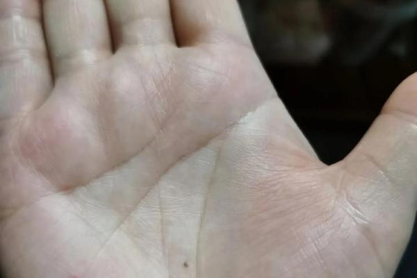 手上痣的不同位置代表什么？从掌纹看健康运势