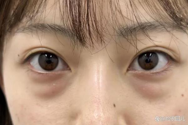 眼袋线揭秘：透视面相中的睡眠负债