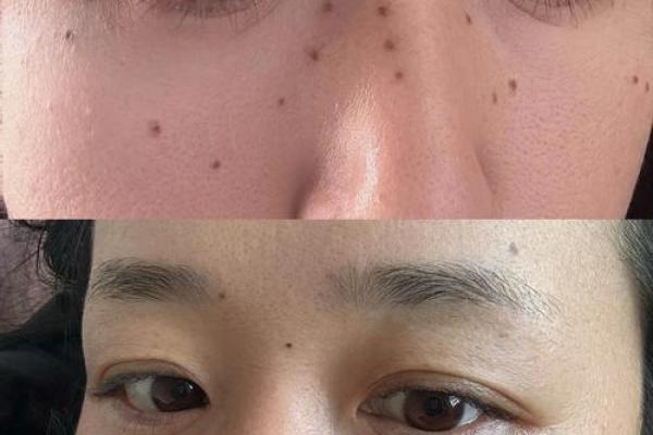 点痣真的会影响运势吗？揭秘神秘面相术