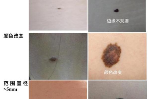 胸前痣吉凶大揭秘，你的痣是好运还是霉运？