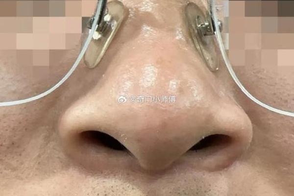 鼻头朝天面相之谜
