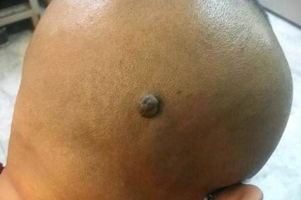 耳朵后长瘊子如何影响个人运气与健康