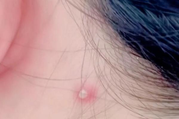耳朵后长瘊子如何影响个人运气与健康