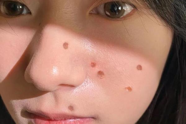 点痣成星：揭秘脸部痣的神奇魅力