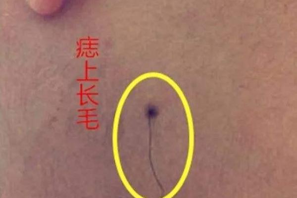 痣相艳色浅痣长毛：揭秘神秘魅力之源