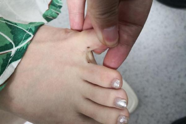 脚趾缝上的痣，究竟暗示了什么？相术揭秘！