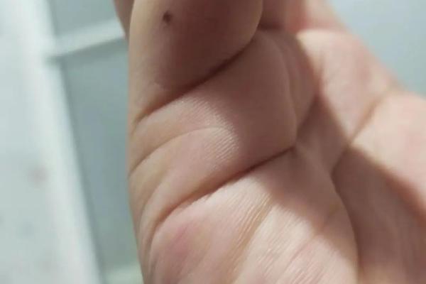 手指背痣：传说中的幸运符，真的存在吗？
