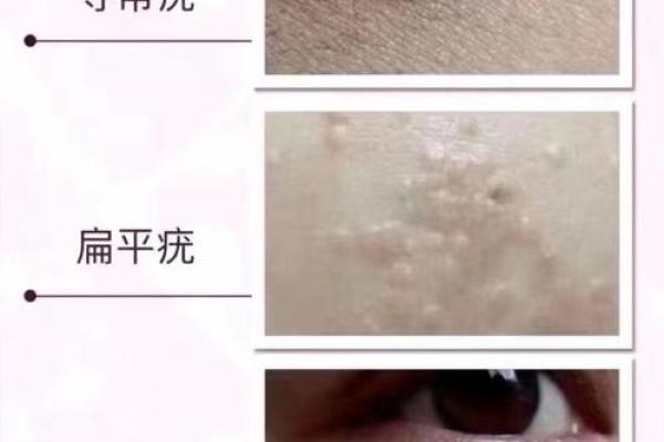 瘊子与风水学：解密身上小斑点背后的大命运