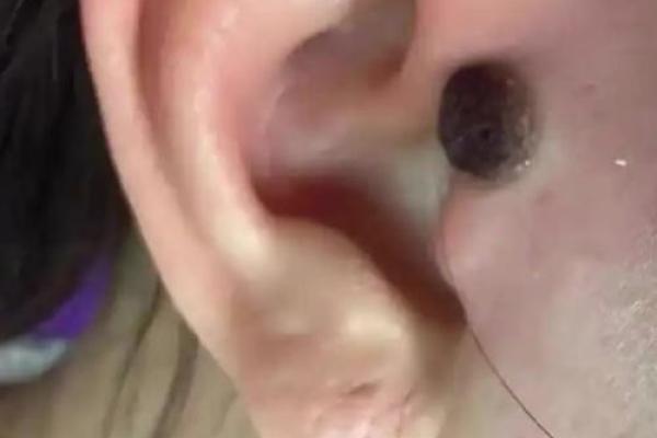 耳后有痣对风水的影响及其破解方法