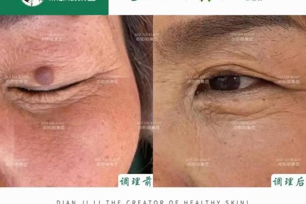 颜值加分项：女人上眼皮痣的神奇力量