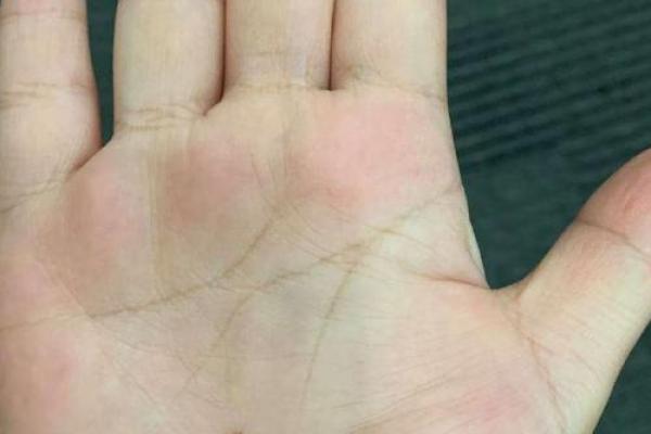 手相大师揭秘：痦子位置大揭秘，运势密码一网打尽！