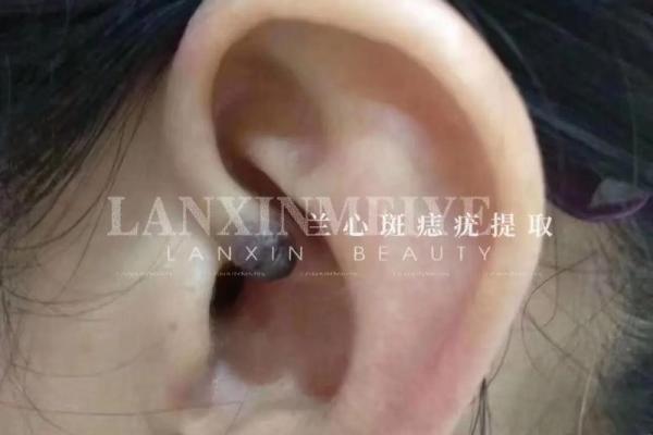 耳畔痣相，财运亨通的神秘信号