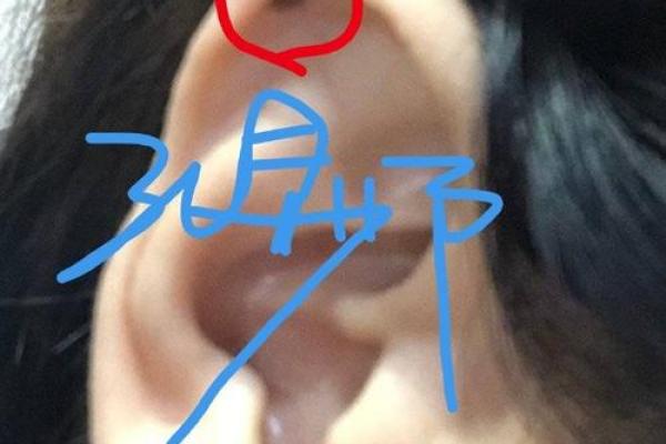 耳朵上部内痣男：健康长寿的标志