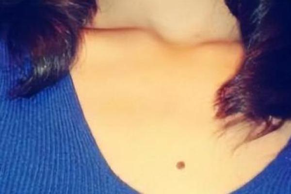 胸侧黑痣揭秘：美丽还是隐患？
