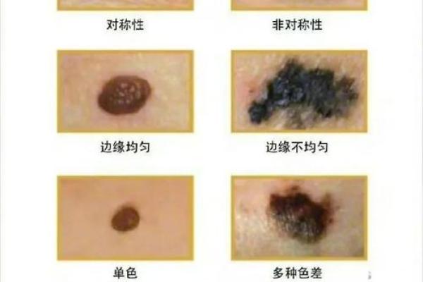 胸侧黑痣揭秘：美丽还是隐患？