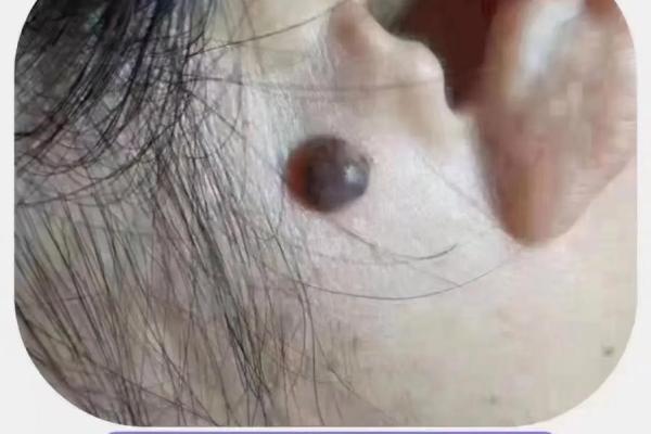 点痣后运势大变，真的假的？