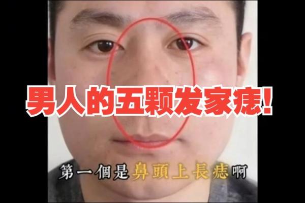 亿万富翁的痣相揭秘：这是否预示着成功？