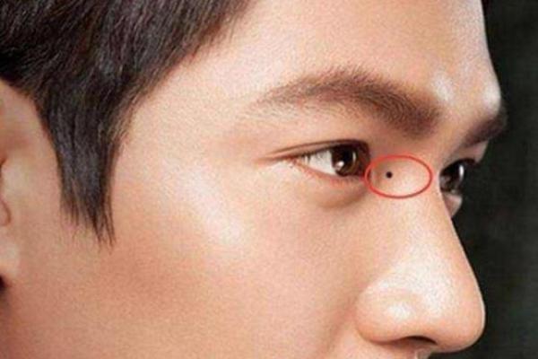 天生贵气,眉头上方痣男子魅力无限 天生贵气,眉头上方痣男子魅力无限