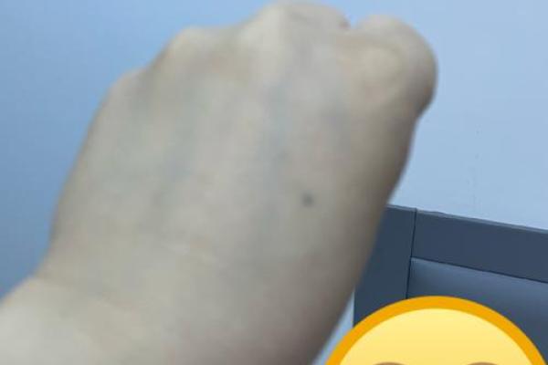 手背痣相女,神秘魅力无法挡! 手背痣相女,神秘魅力无法挡!