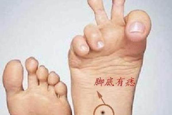 脚底痣相解读,看透你的财运、健康与运势! 脚底痣相解读,看透你的财运、健康与运势!