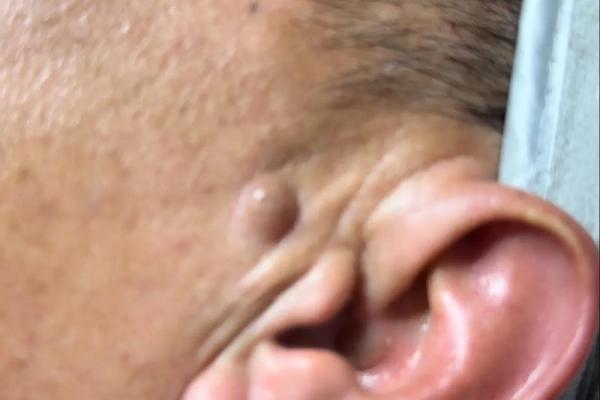 耳后藏珠,运势亨通的神秘痣相 耳后藏珠,运势亨通的神秘痣相