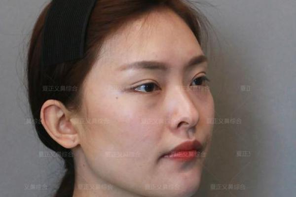 鼻翼窄显内敛