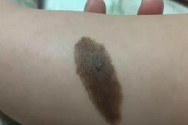 痣相解读:长毛毛的人命运如何? 痣相解读:长毛毛的人命运如何?